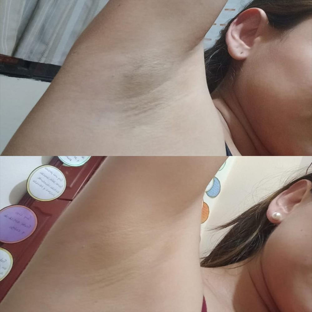 Crema Despigmentante Quita Manchas Axilas, Zona Intima, Codos 60Ml 3 Unidades img #5