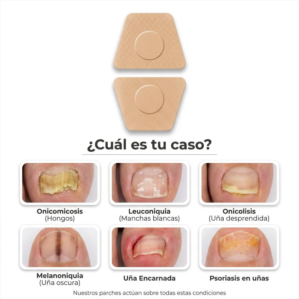 Parches Natural Correctores Uñas Encarnadas Hongos Pie 10Und img #4